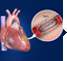 Coronary Angioplasty and Stenting